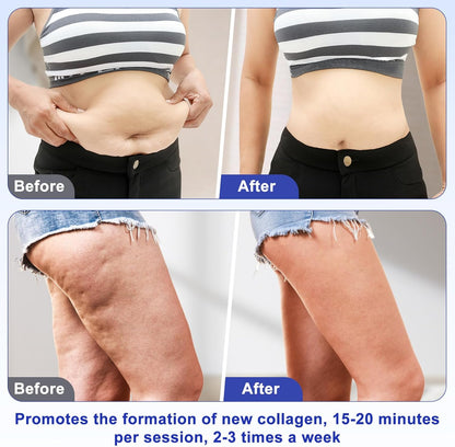 40K Cellulitis Massageapparaat – Anti-Cellulitis Apparaat – Afslankapparaat – Cavitatieapparaat – Radiofrequentieapparaat – 4-In-1 – 10 Intensiteitsniveaus