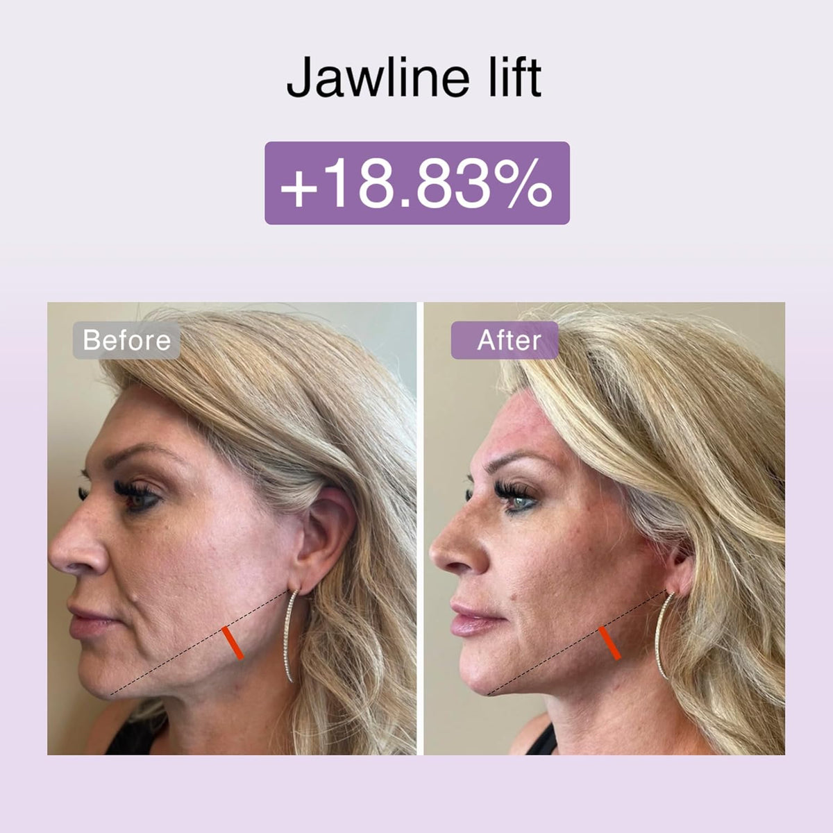 DermRays laser apparaat m1